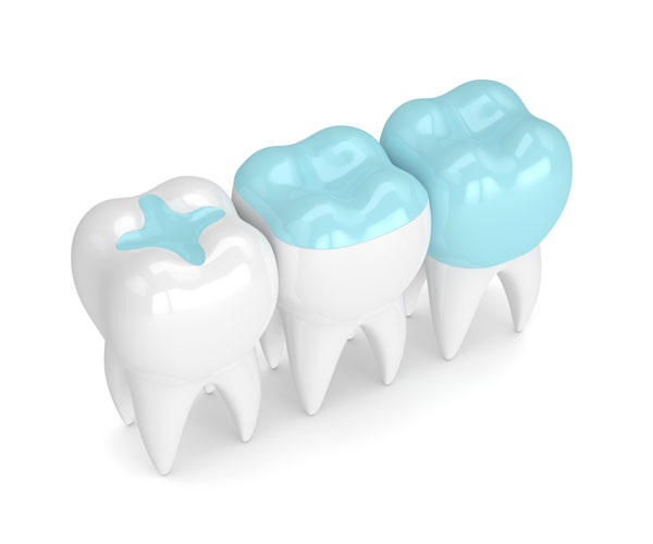 dental-sealants-belleview-dental-01