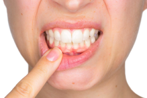 What is the Main Cause of Gum Disease?