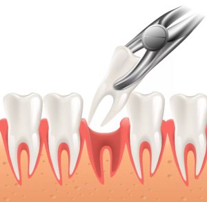 Tooth Extactions in Denver, CO