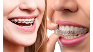 An Introduction to a straight smile: Braces or Invisalign