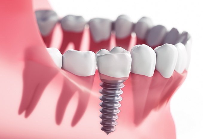Dental Implants in Denver