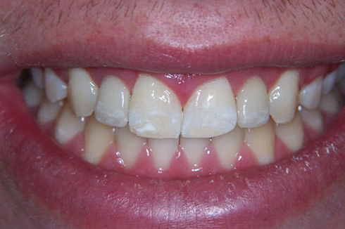 Picture of the teeth after a dental procedure
