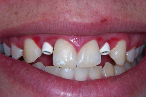 Picture of the teeth before a dental procedure