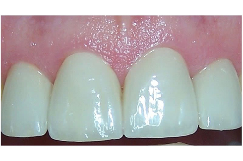 Picture of the teeth after a dental procedure