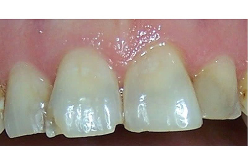 Picture of the teeth before a dental procedure