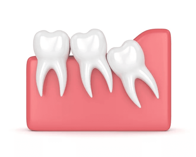 3D rendering of impacted wisdom tooth pressing against other teeth – illustrating the need for wisdom tooth removal.