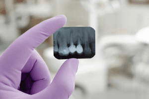 Hand holding a result of dental Xray.