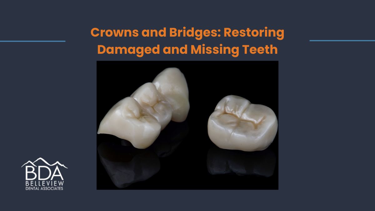 Crowns and Bridges