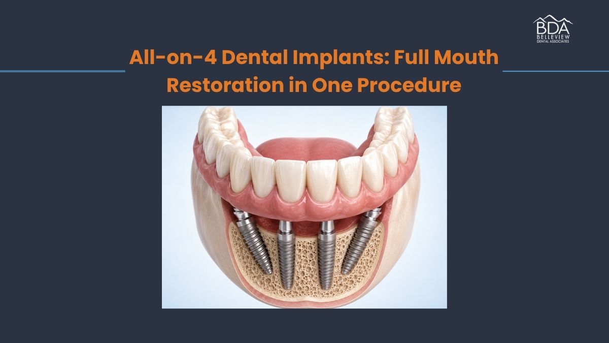 All-on-4 Dental Implants