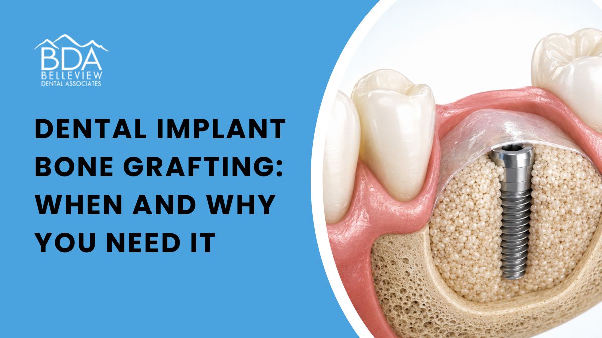 Dental Implant Bone Grafting