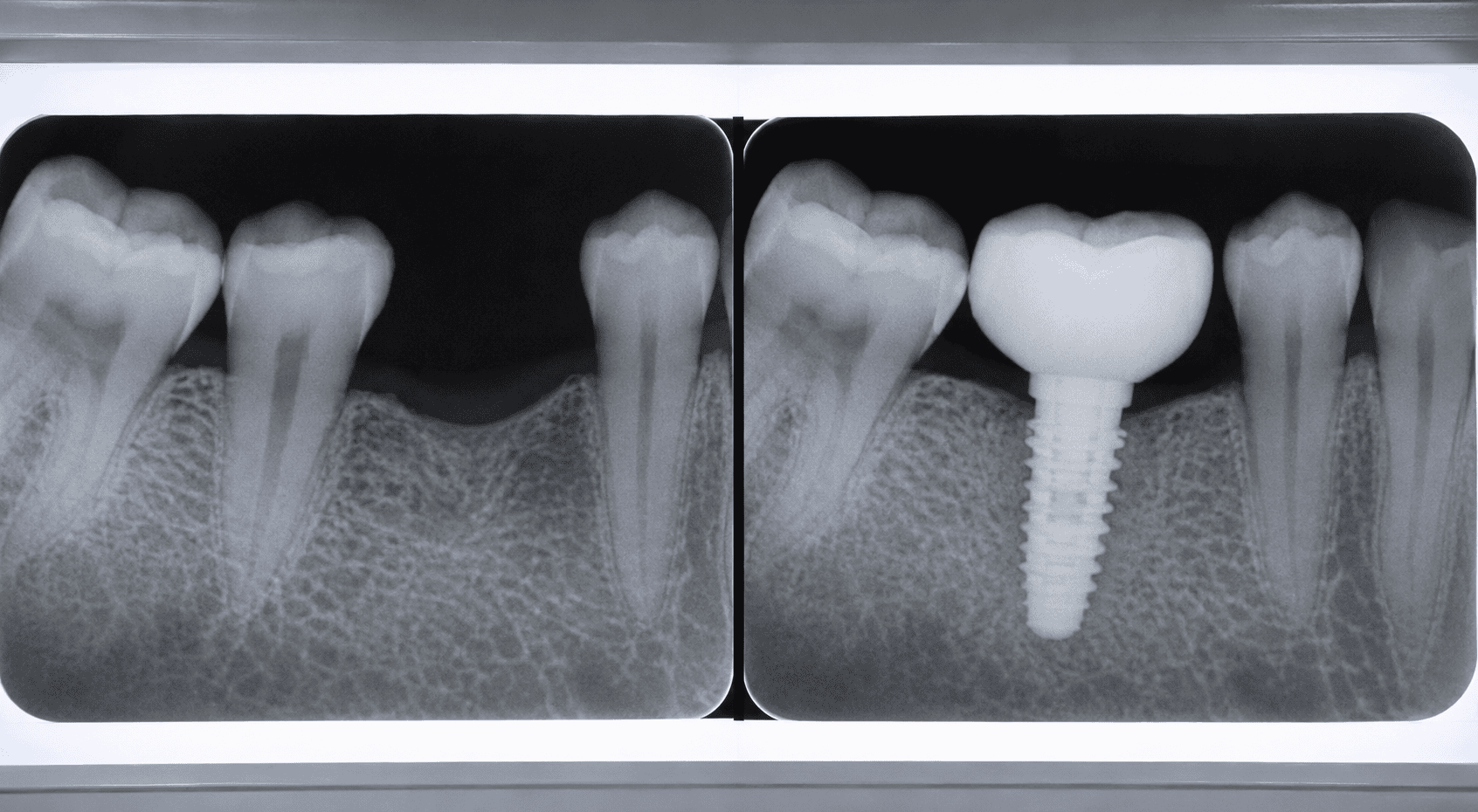 Dental Implants in Littleton CO